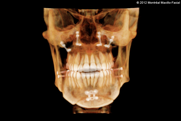 Marie-Hélène Cyr - 3D scan (front) after orthodontic treatments and orthognathic surgeries (February 13, 2012)